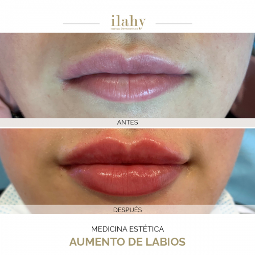 Aumento de labios - Caso de antes y despu�s